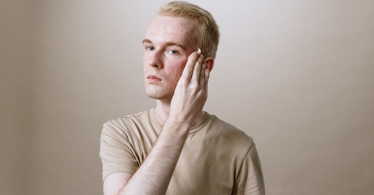 Acne Tarda pod lupą: dlaczego wraca w dorosłości i jak ją skutecznie opanować
